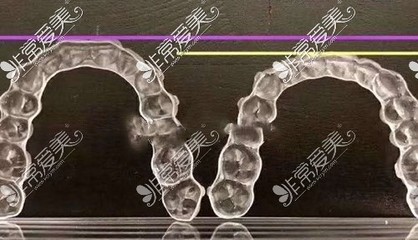 可刷医保的成都市军大口腔科,牙齿矫正黑科技Comfos隐形矫正